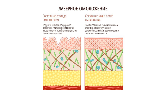 эрбиевый лазер в Coolaser clinic