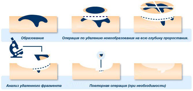 Как удаляют новообразования в Coolaser clinic