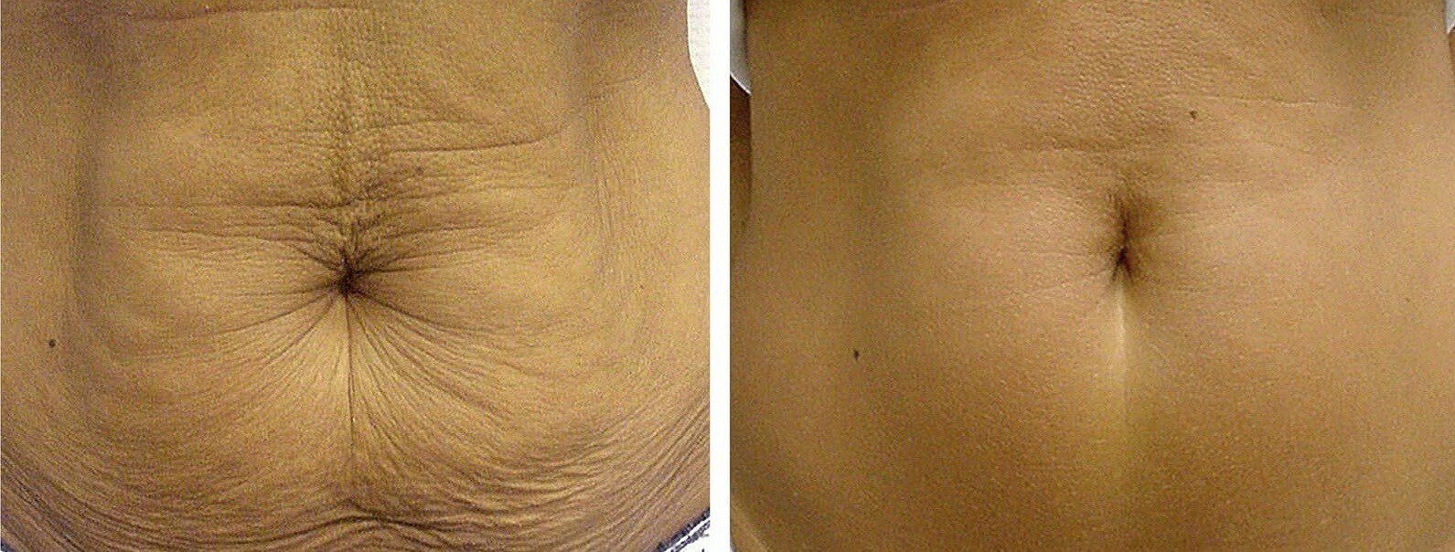 Skin tightening for stomach - Coolaser Clinic