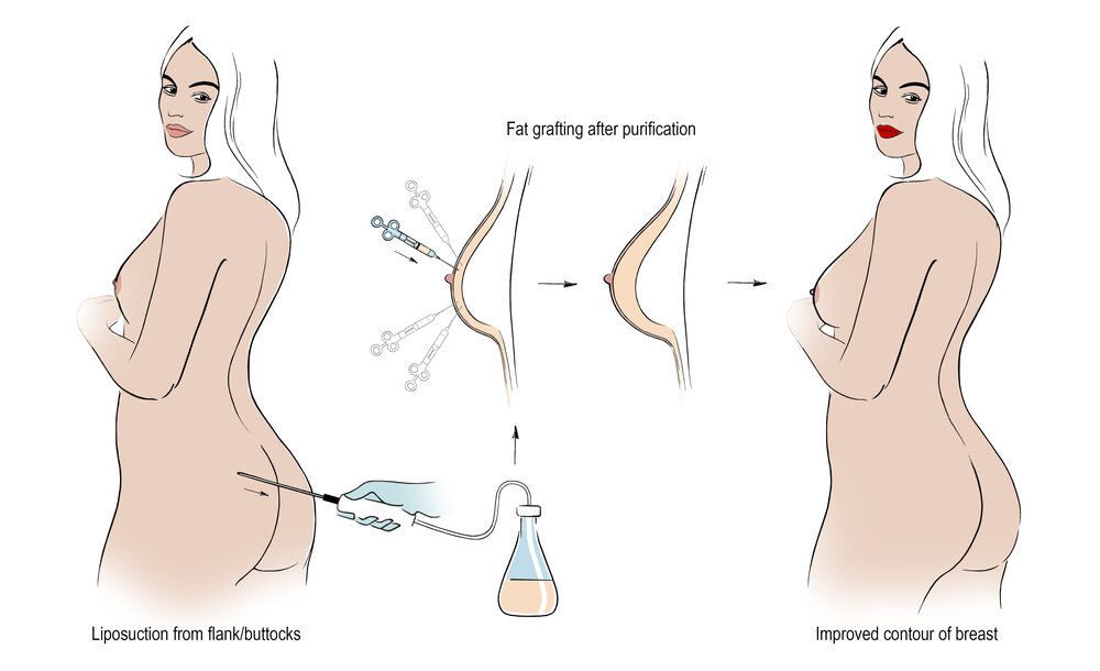 Увеличение груди с пересадкой жира | биржевые-записки.рф