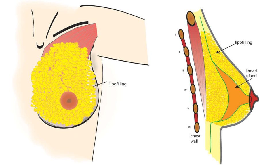 Липофилинг Груди Фото