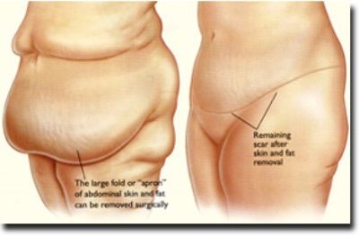 Pre-operative Marking Of The Abdominal Note The Pannus , 44% OFF