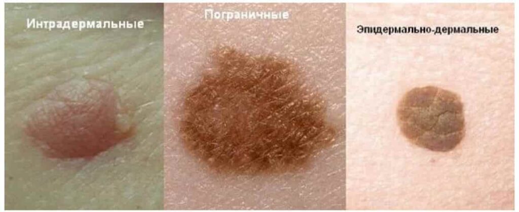 Как убрать шрамы на лице в домашних условиях - Coolaser Clinic