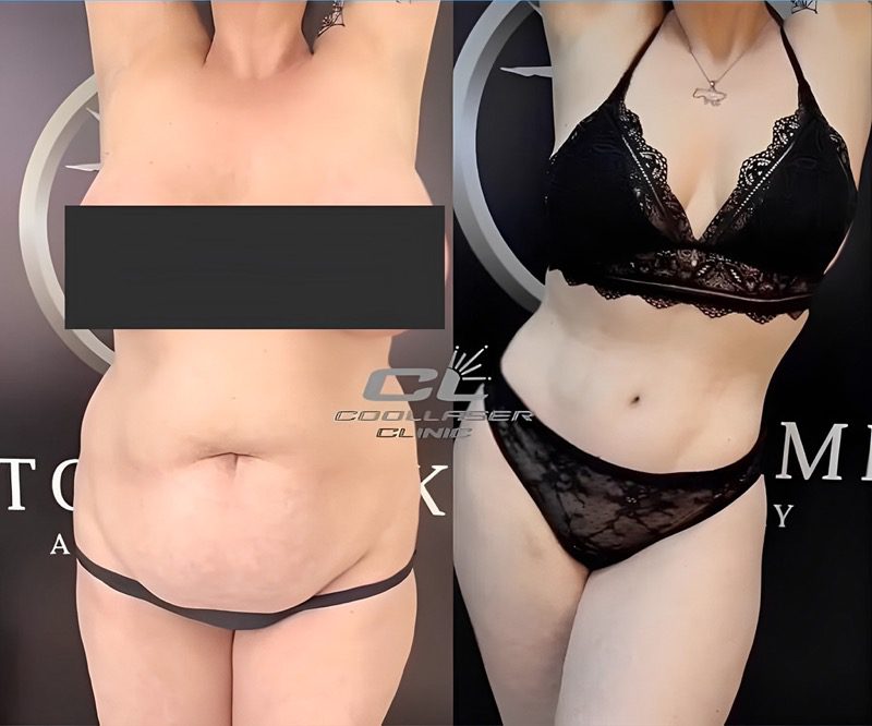 Plastic surgery of the female body. Liposuction of the hips, legs, tummy  tuck, waist. Drawing arrows and lines with perforation for preparation for  surgery. Fat woman in underwear isolated Photos