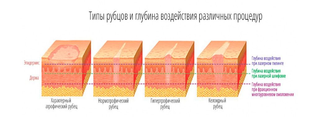 Сколько дней заживает после. Лазерная шлифовка рубца этапы заживления. Стадии заживления шрама атрофического. Нормотрофический рубец.