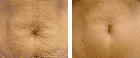 Laser skin store tightening stomach