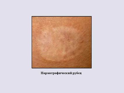 Нормотрофический рубец