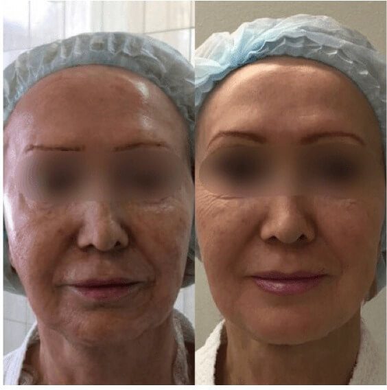 Effective rejuvenation procedures - Coolaser Clinic