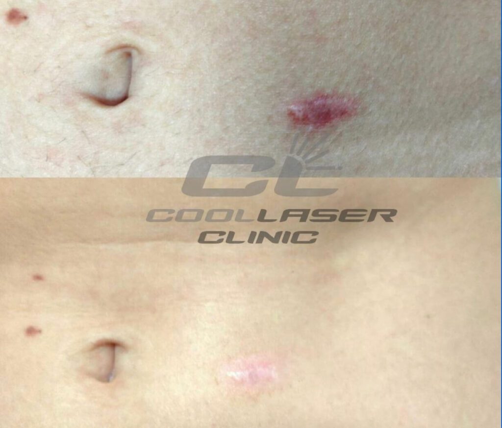 Лазерное удаление шрамов на теле в Киеве – Coolaser Clinic