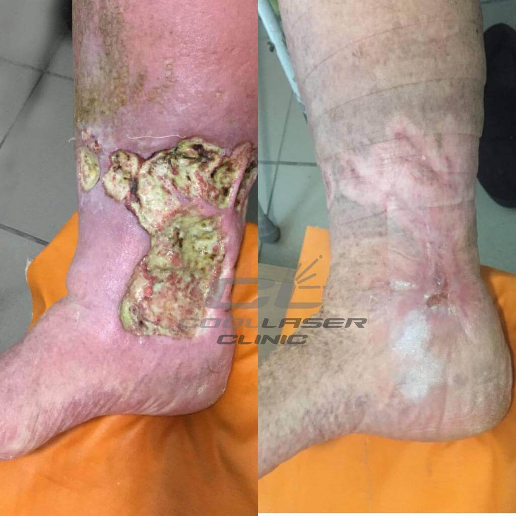 Фото До и После лечения незаживающей раны голени  Before and after treatment of non-healing shin wound