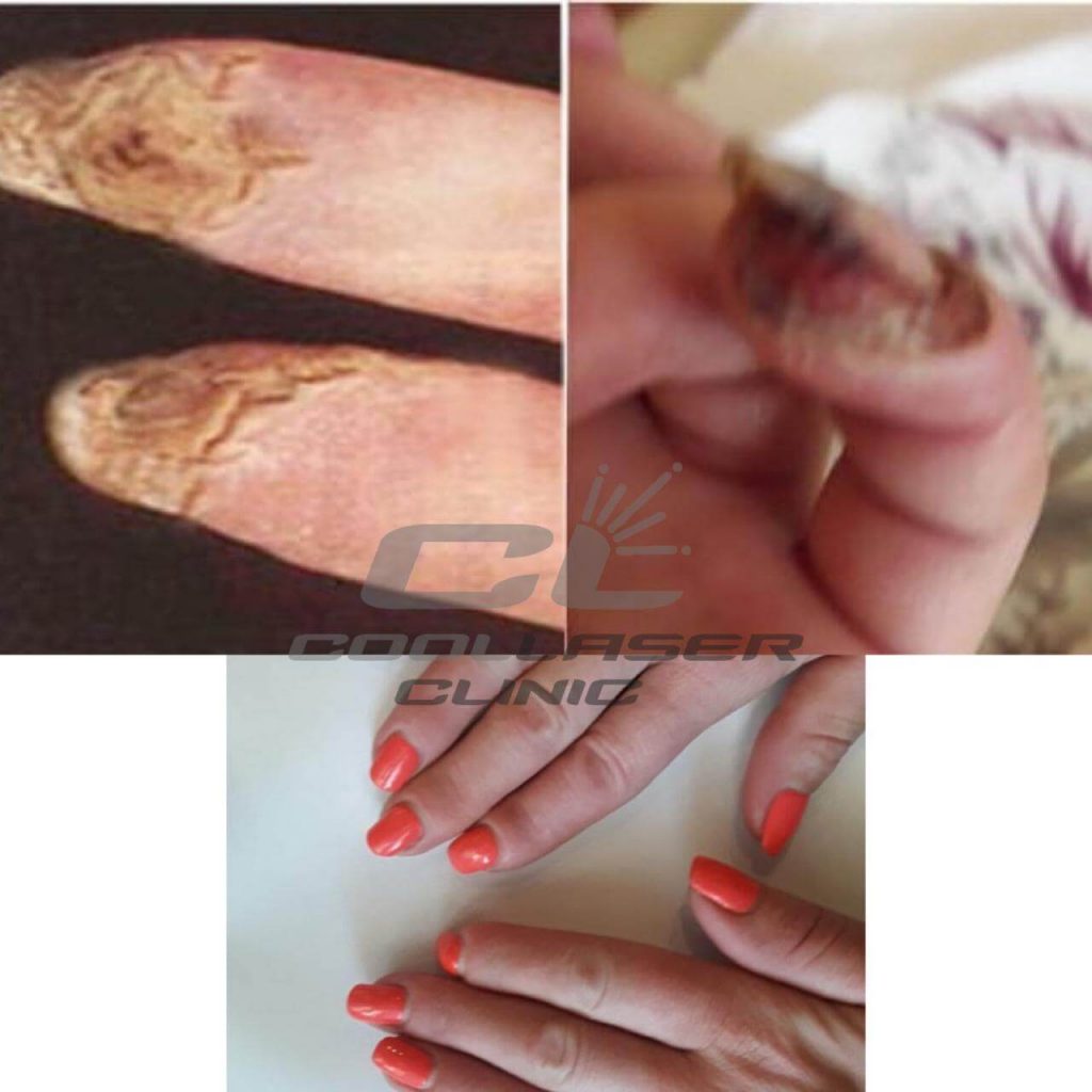 Фото До и После лечения склеродермии Before and After Photos of Scleroderma