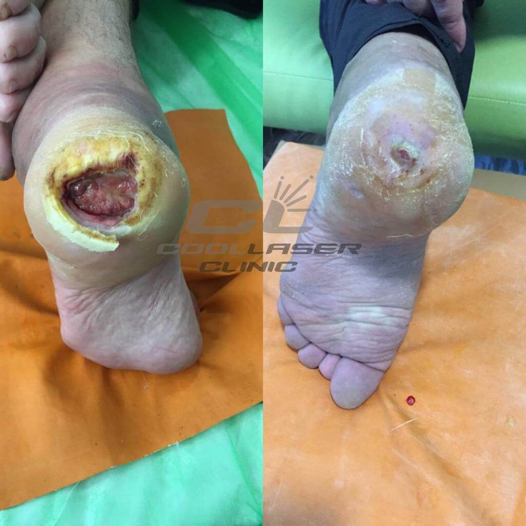 Фото До и после незаживающая рана стопыBefore and after photos of a non-healing foot wound