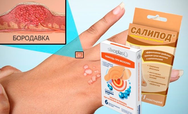 How to get rid of warts using salicylic acid
