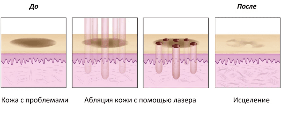 Фракционная лазерная обработка кожи