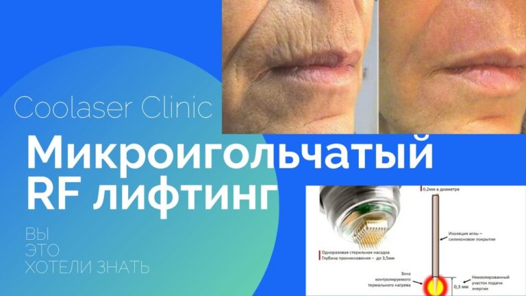 Микроигольчатый RF лифтинг Цена