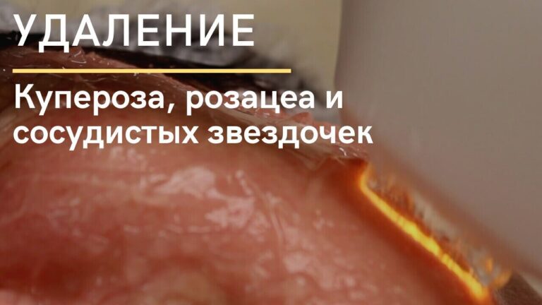 Лечение купероза, розацеа и сосудистых звездочек