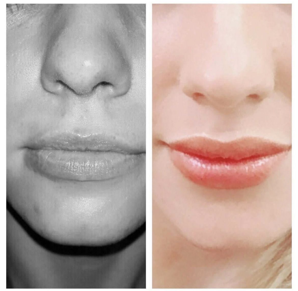 Increased volume of the lips