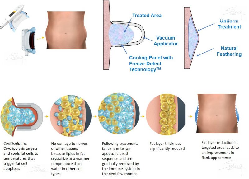 How the device works CoolScolpting procedure