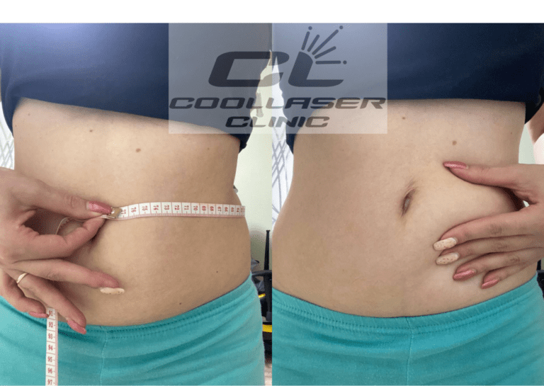 How to Reduce Waistline - Coolaser Clinic