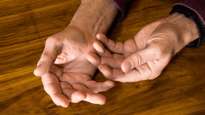 psoriatic arthritis