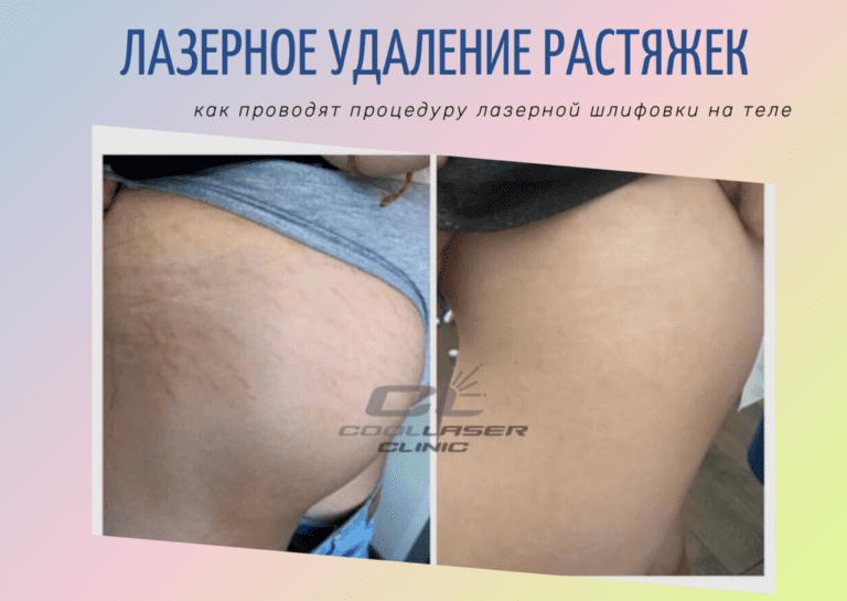 лазерное удаление растяжек