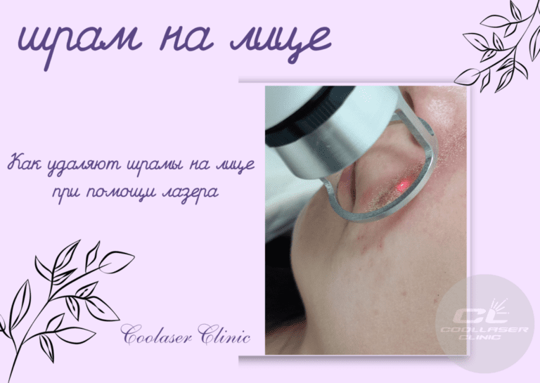 удалить шрам на лице