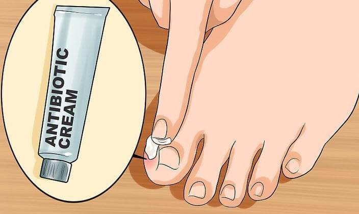 nail fungus photo