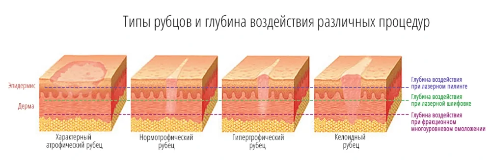 виды шрамов и рубцов на теле