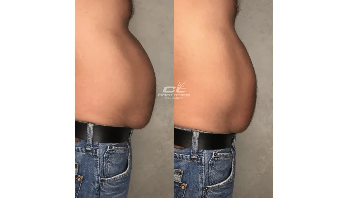 Stem cells for weight loss are a reality!