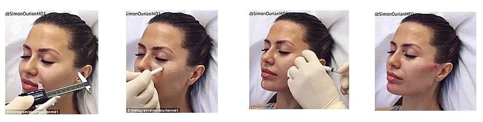 Коррекция скул Coolaser clinic