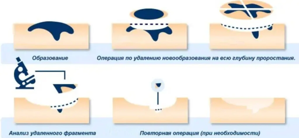 Лазерное удаление бородавки