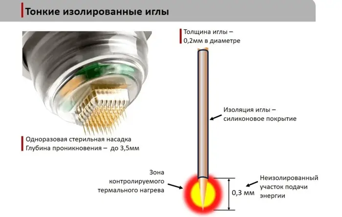 Ігли Мікроголчастого РФ