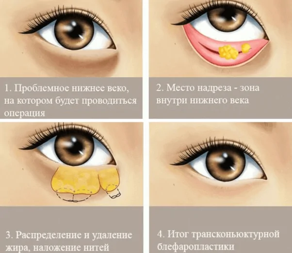 Блефаропластика нижних век картинка