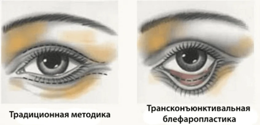 Трансконъюктивальная блефаропластика картинка