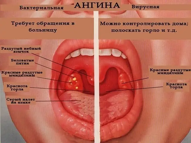 Лечение ангины народными средствами. фото