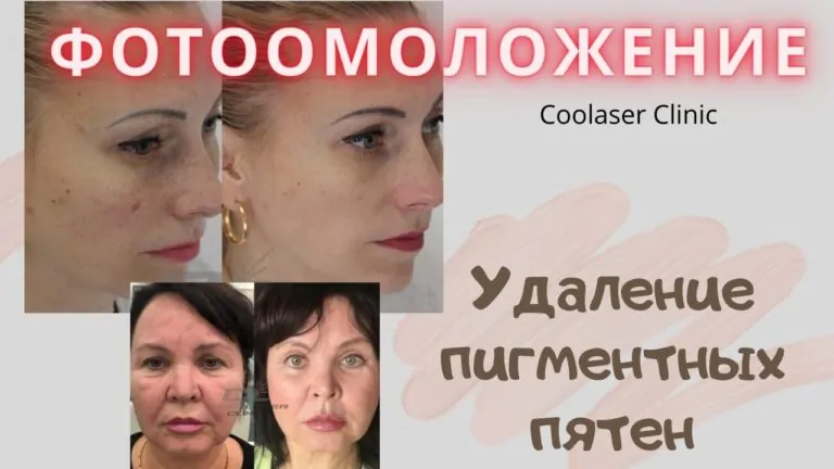 Фотоомоложение и удален пигмент пятен