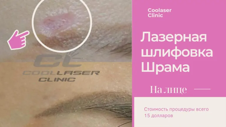 Удаление шрама