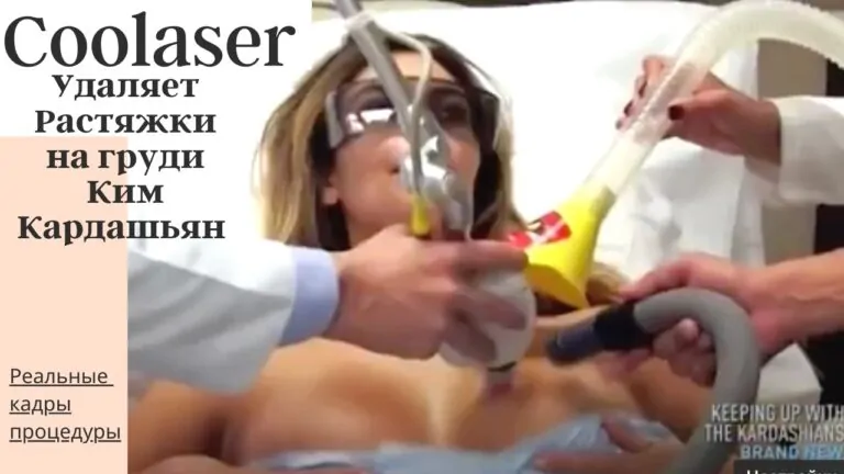 Coolaser удаляет растяжки ким Кардашьян фото