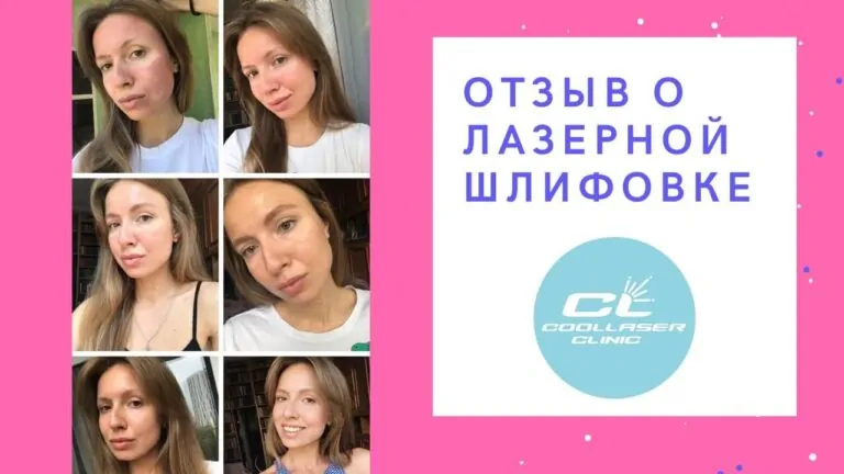 Отзыв о лазерной шлифовке СО2