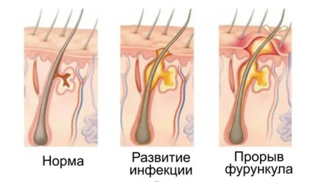 Симптом фурункулеза