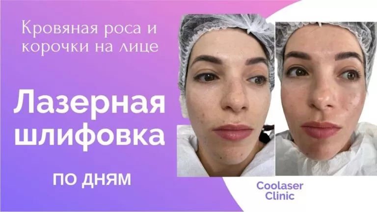 Шлифовка лица по дням