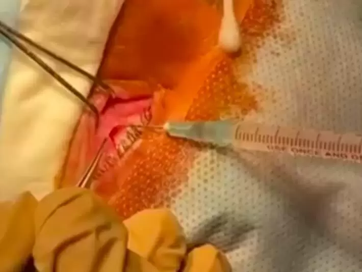 Процесс клеточной терапии клеточная терапия атрофии зрительного нерва