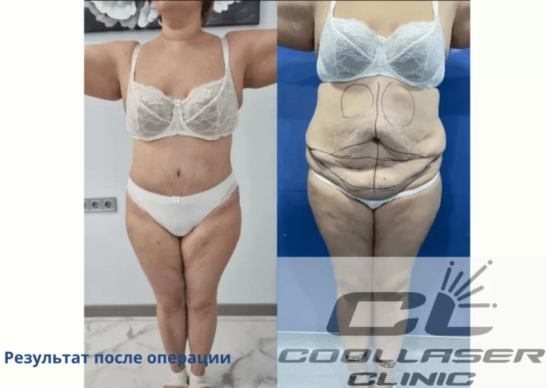 циркулярная абдоминопластика