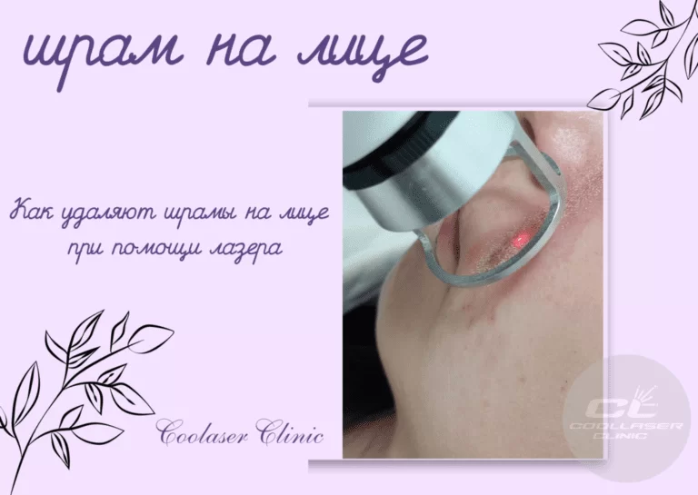 удалить шрам на лице