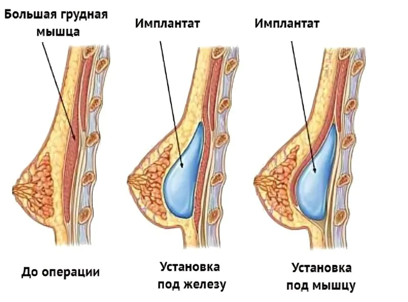 Места установки грудного имплантата